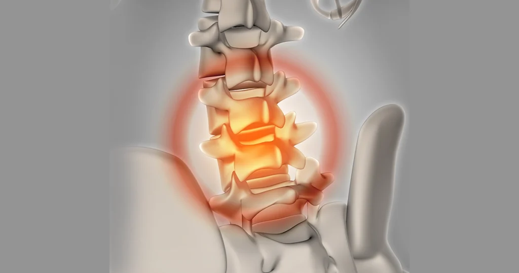3D illustration showing inflamed lower spine disc pain